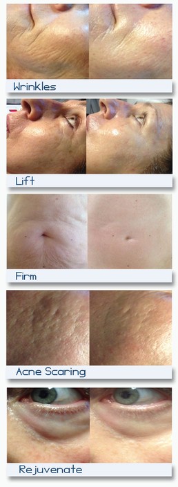 infuse skin clinic Pic 1 - Collagen Induction Therapy Befores and Afters