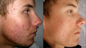 Longevity Lounge esthetics Pic 4 - acne treatment