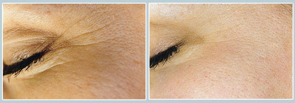 Via Esthetica Pic 2 - microdermabrasion