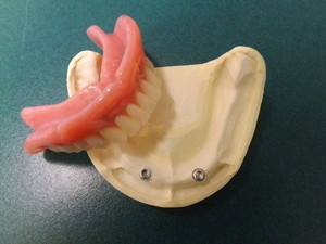 Paul Franco Denture Clinic Pic 4 - Implant retained dentures