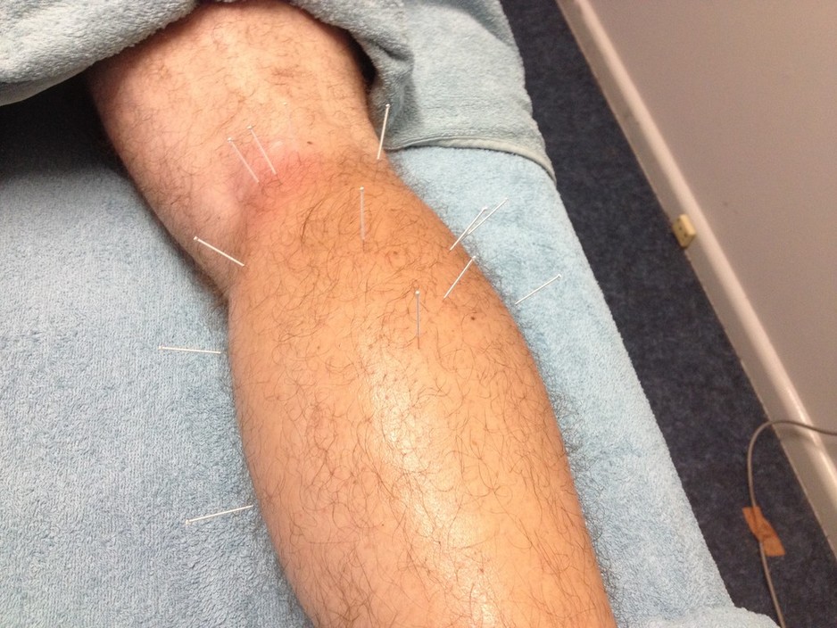 BODYWORKX clinic - Myotherapy Pic 1 - dry needling