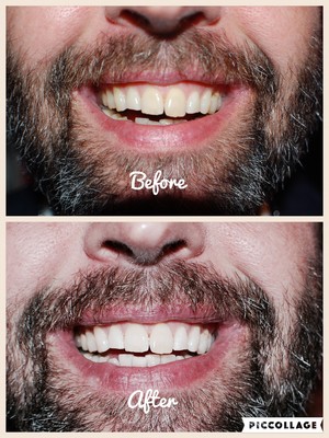 Express Teeth Whitening Canning Vale Pic 4