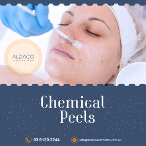 Aldaco Aesthetics Pic 2 - Chemical Peels at Aldaco Aesthetic