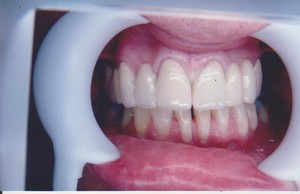 International Smiles Pic 3 - 1 After Stain blast cleaning 8 fillings sinus lift and 2 implants