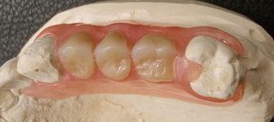 Pro Dent Clinic Pic 5 - flexible synthetic partial denture on a plaster model