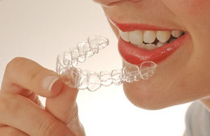 Accent Dental Care Pic 2 - Invisalign Invisible Braces