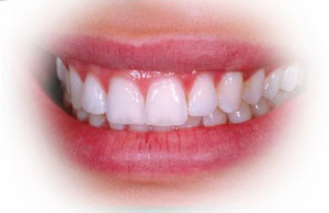 Accent Dental Care Pic 3 - Teeth whitening using Zoom Technology