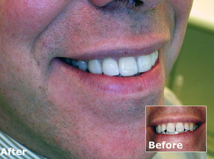 Accent Dental Care Pic 5 - Veneers