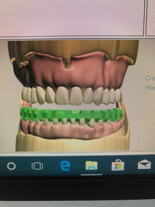 Kroma Ceramics Pic 1 - Digital Dentures 3Shape Ivolcar software