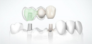 Park Terrace Dental Pic 3 - Implant placements