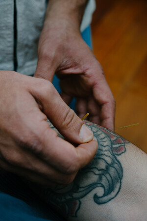 Melbourne Massage and Treatment Pic 4 - Dry Needling on forearm