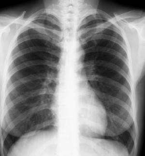 Ultrasound & X-Ray Acacia Ridge Pic 3 - Chest Xray