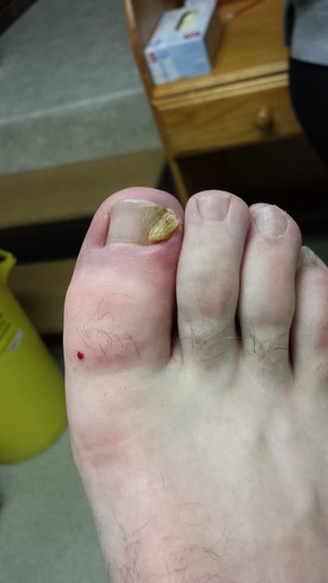 Wantirna Mall Podiatry Pic 5 - Ingrown toe nail