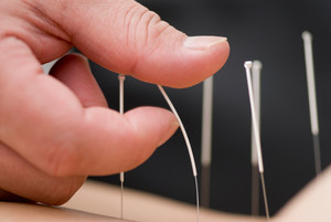 Sustain Health Pic 4 - Acupuncture