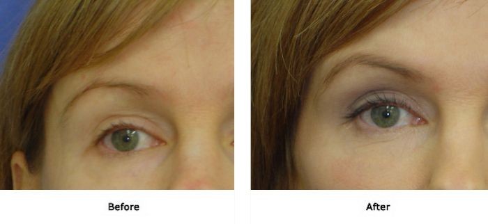 Dr M Szalay Pic 1 - Brow Lift