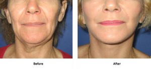 Dr M Szalay Pic 2 - Facelift Lift Plus Neck and Jowls