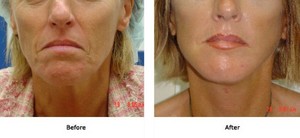 Dr M Szalay Pic 3 - Facelift Lift Plus Jowls and Midface