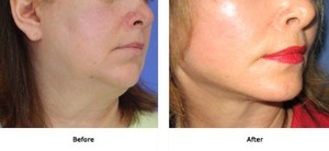 Dr M Szalay Pic 4 - Facelift Lift Plus Neck and Jowls and neck liposuction