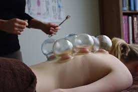 Redlands Remedial Therapy Clinic Pic 4 - Traditional Flame Cupping