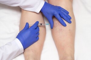 The Vein Institute Pic 5 - Sclerotherapy treatment for varicose veins