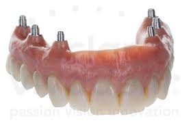 Castle Hill Denture Clinic Pic 4 - Implant Overdentures