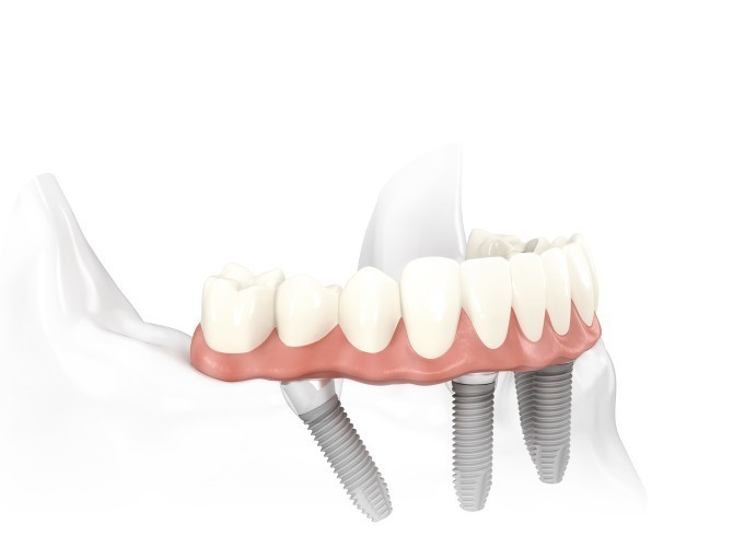 Specialist Oral Surgery Pic 1 - all on 4 dental implants perth