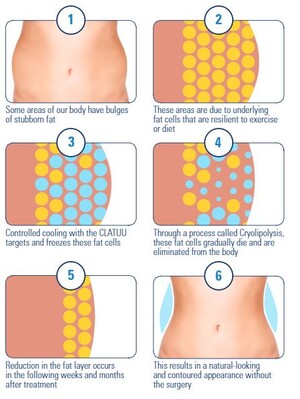 The Derma Contour Pic 4 - Fat Freezing Clatuu Alpha allows you to go through a safe and quick procedure where unwanted fat is frozen and destroyed