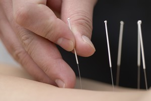 Discover Chinese Medicine Pic 3 - acupuncture is painless and can treat many health conditions