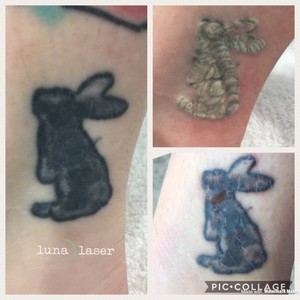 Luna Laser Pic 3 - First treatment of tattoo removal Photo taken 2 days after