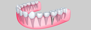 JK Dental Pic 5 - Dental Implants Melbourne