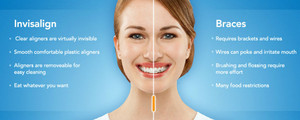 Kallangur Dental Surgery Pic 2 - invisalign vs braces charge up your smile today with new technology