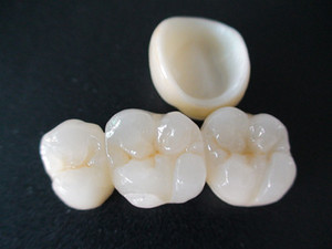 Kallangur Dental Surgery Pic 4 - smile with us have your crowns and bridges done in best quality