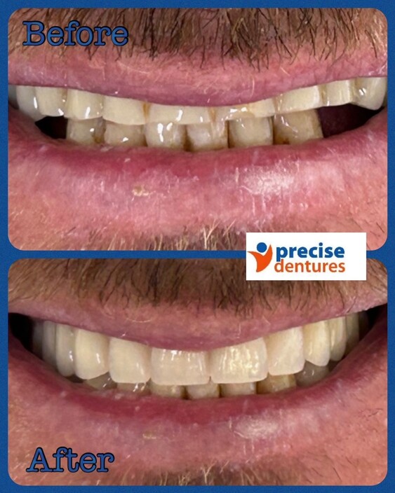 Precise Denture Clinic Pic 1 - Full over full dentures