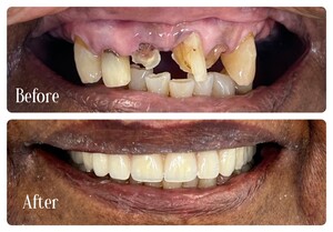 Precise Denture Clinic Pic 3 - Immediate dentures made to insert on the day of extractions