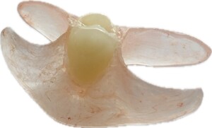 Precise Denture Clinic Pic 5 - Partian one tooth denture in flexible material