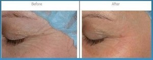 Revitalise You Pic 2 - Radio Frequency Treatment Tighten Skin remove wrinkles on most pats of the body