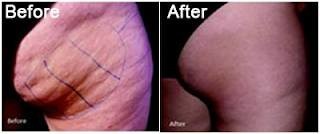 Revitalise You Pic 1 - Ultrasound Liposuction to remove unwanted fat Cellulite