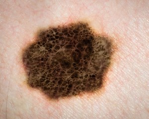 Dr Jeremy O'Brien Pic 2 - melanoma