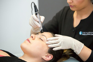 Victorian Cosmetic Dermal Clinics Berwick Pic 5 - Microdermabrasion