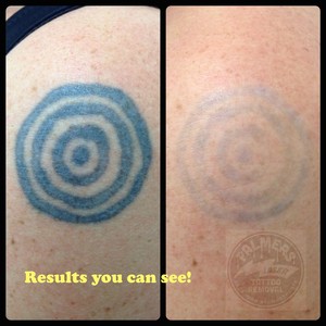 Palmers Laser Tattoo Removal Pic 3