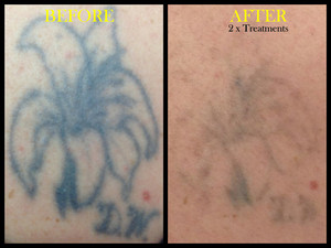 Palmers Laser Tattoo Removal Pic 2