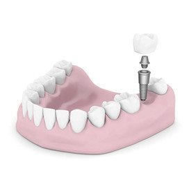 Dental Implant Clinic Pic 5