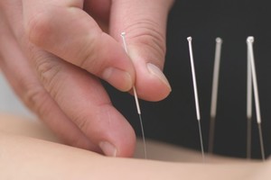 Rouse Hill Wellness Centre Pic 5 - acupuncture clinic Hills District