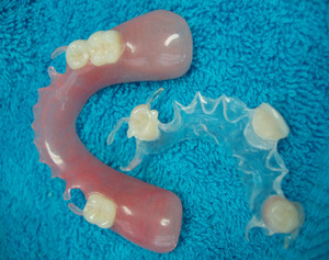 C.K. Denture Clinic Pic 4 - Thermoplastic Flexible Hybrid Denture