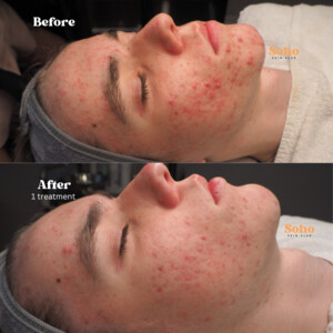 Soho Skin Club Subiaco Pic 4 - Acne before After