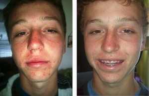 Karmic Beauty Pic 2 - Acne Treatment