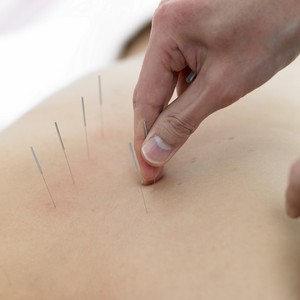 Silver Needle Acupuncture Clinic Pic 4