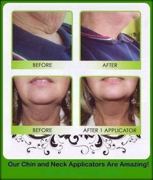 Tighten, Tone and Firm in as Little as 45minutes!!! Pic 4 - Before and after using the neck and chin applicator