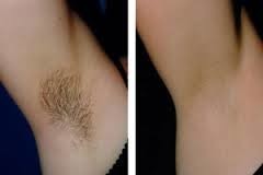 Essential Body Sanctuary Pic 2 - PAIN FREE SHR Permanent Hair Reduction