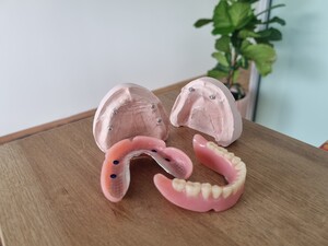 The Dental Corner Pic 3 - Implant overdentures